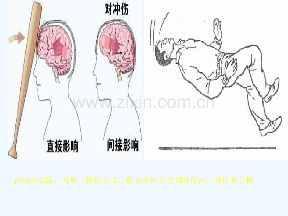 颅脑损伤大同医院神经内科.pptx_第3页