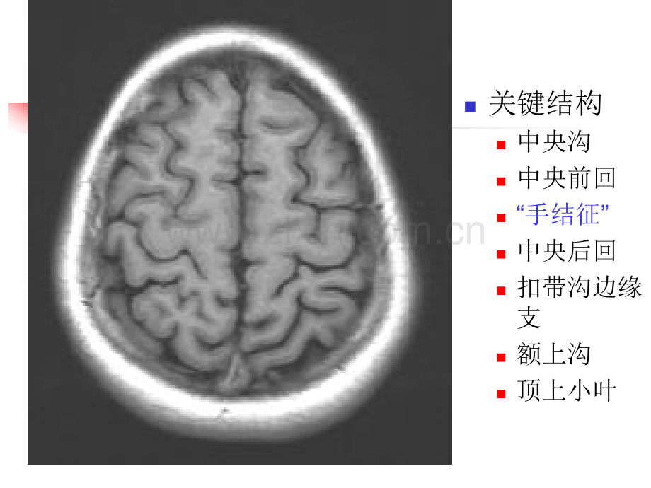 颅脑MRI横断层解剖.pptx_第2页