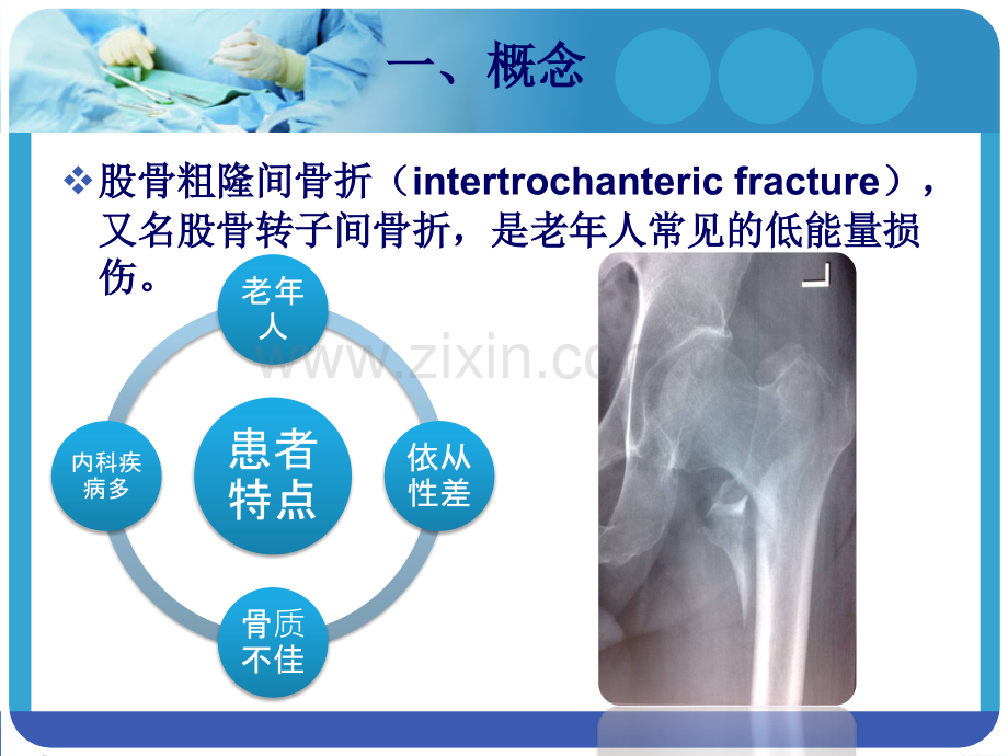 PFNA在股骨粗隆间骨折应用.pptx_第3页