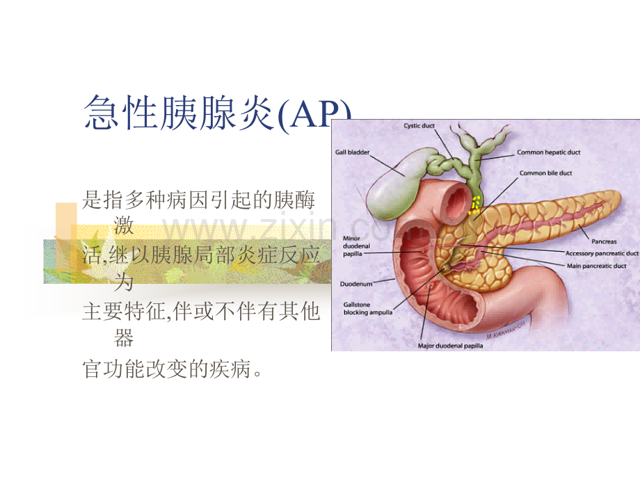 重症胰腺炎和.pptx_第1页