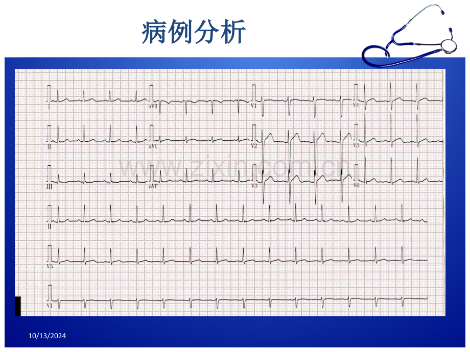 急性胸痛诊治流程.pptx_第3页