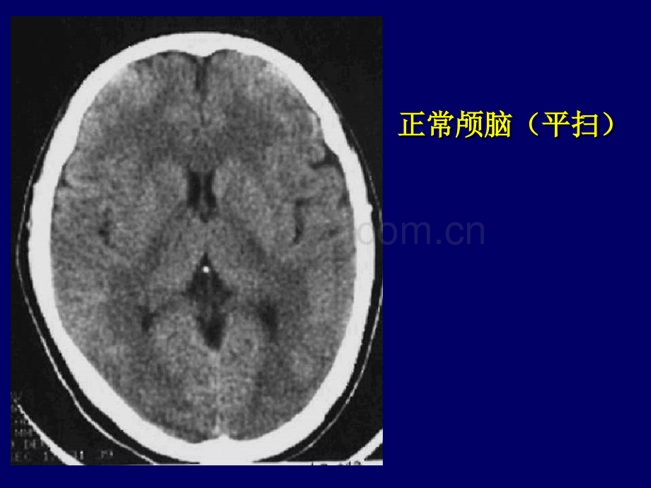 颅脑CT诊断读片.pptx_第1页