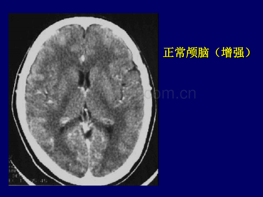 颅脑CT诊断读片.pptx_第2页