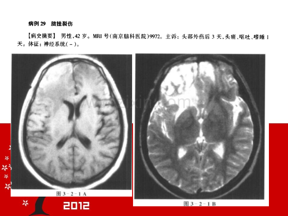 颅脑损伤的mri诊断.pptx_第1页