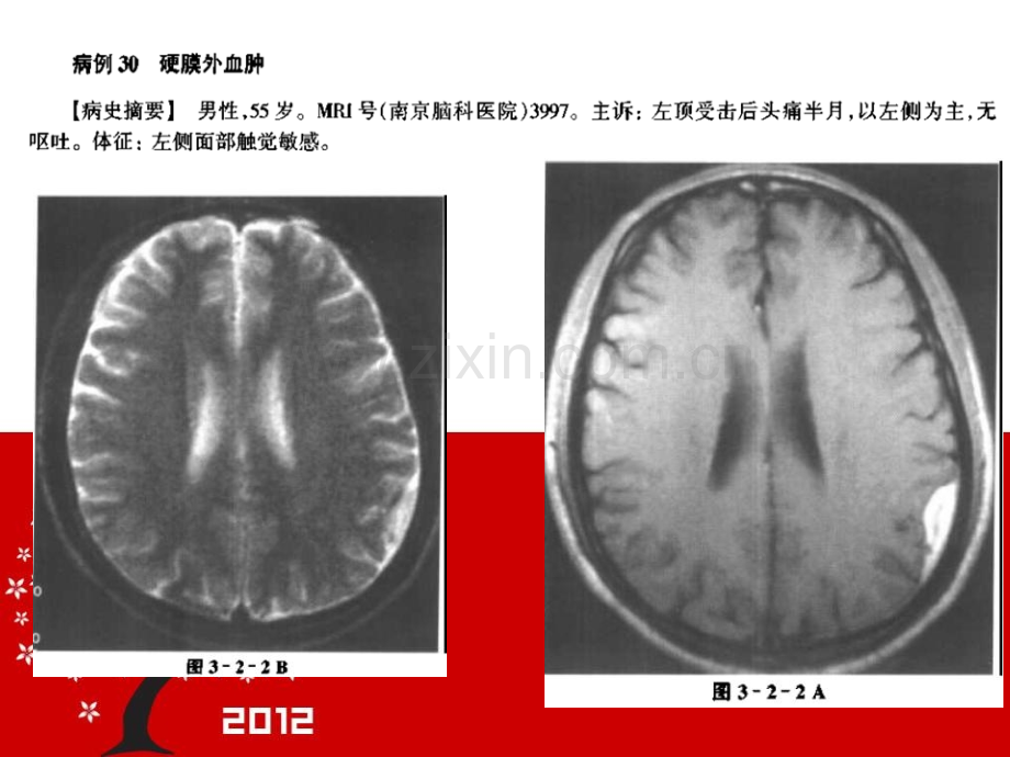 颅脑损伤的mri诊断.pptx_第3页