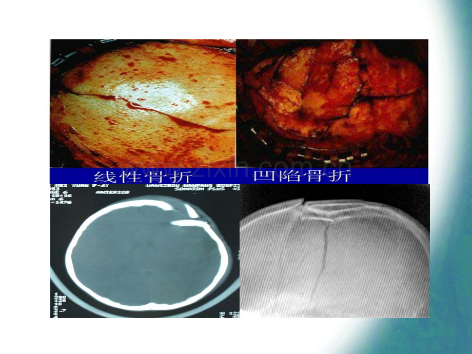 颅骨凹陷性骨折复.pptx_第3页