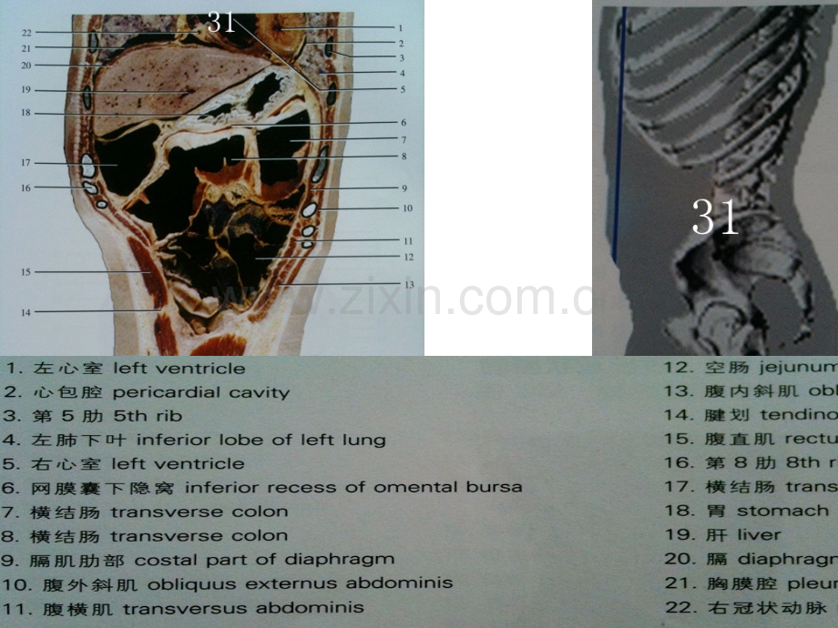 人体断面解剖图谱09-腹部冠状断面.pptx_第2页