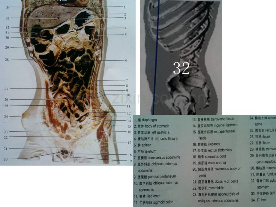人体断面解剖图谱09-腹部冠状断面.pptx_第3页