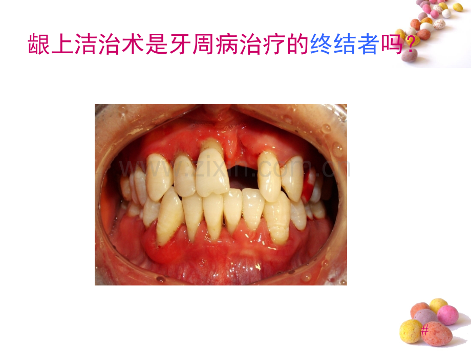 龈下刮治术1.pptx_第2页