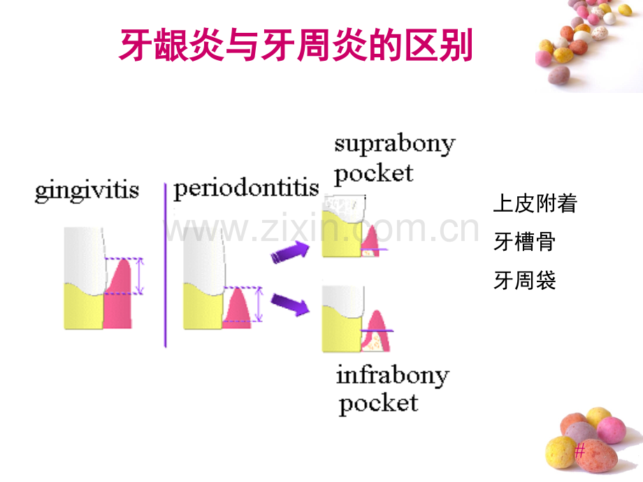 龈下刮治术1.pptx_第3页