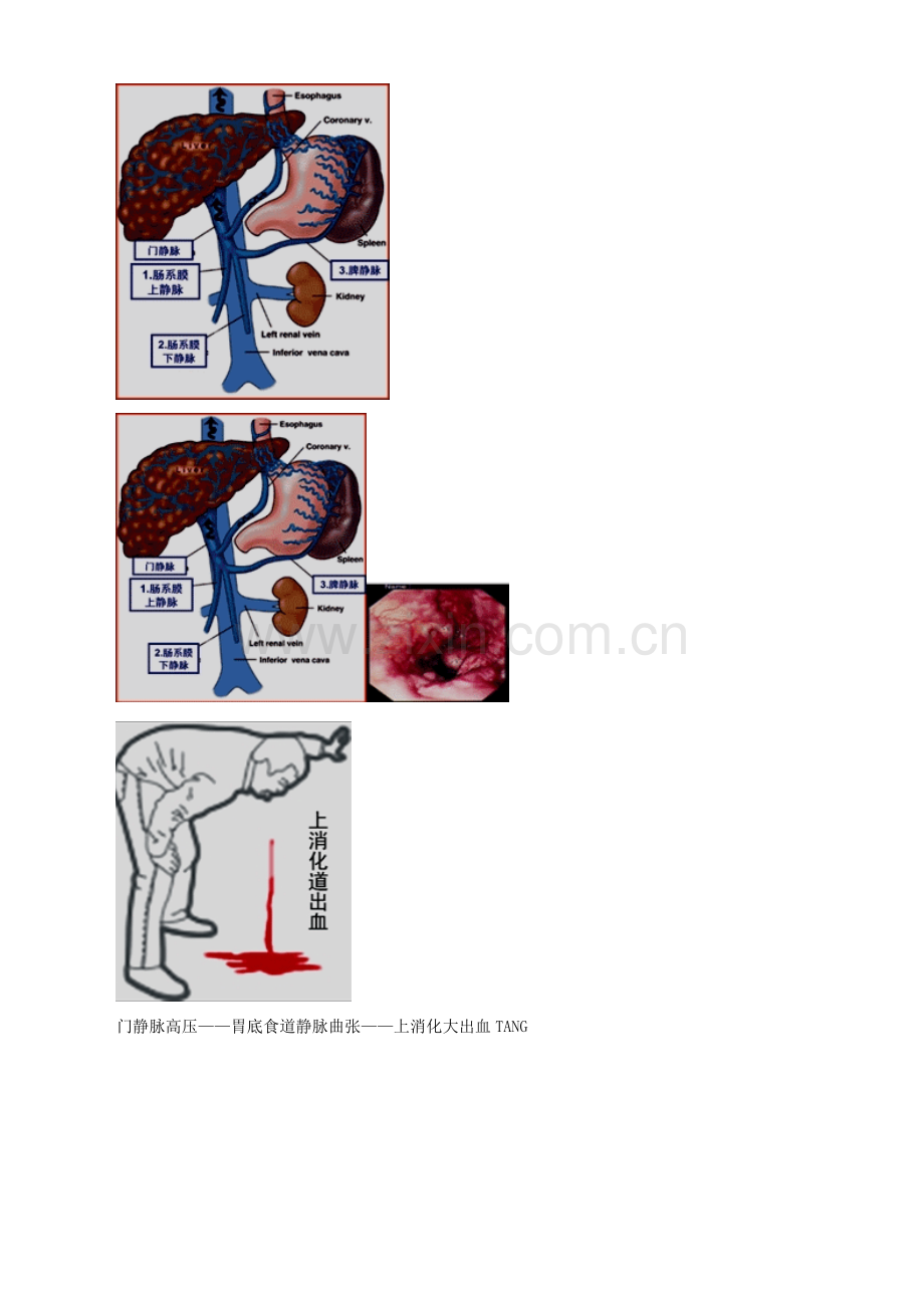 主管护师外科讲义门静脉高压症病人的护理.doc_第2页