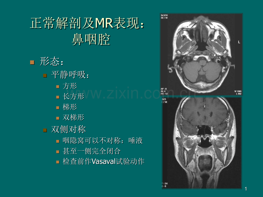 鼻咽癌MR诊断.pptx_第1页