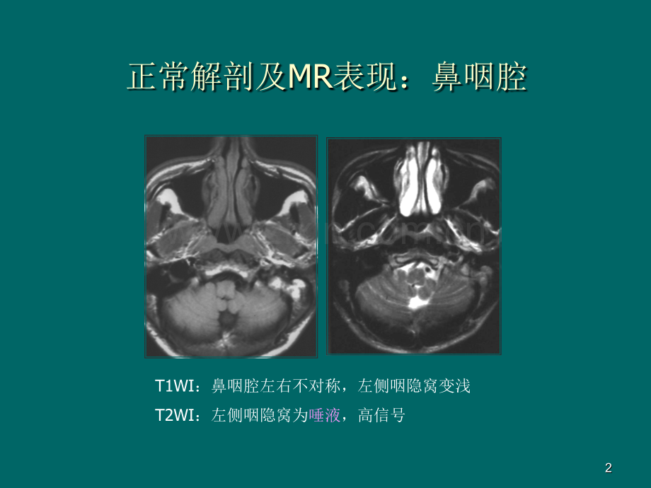 鼻咽癌MR诊断.pptx_第2页