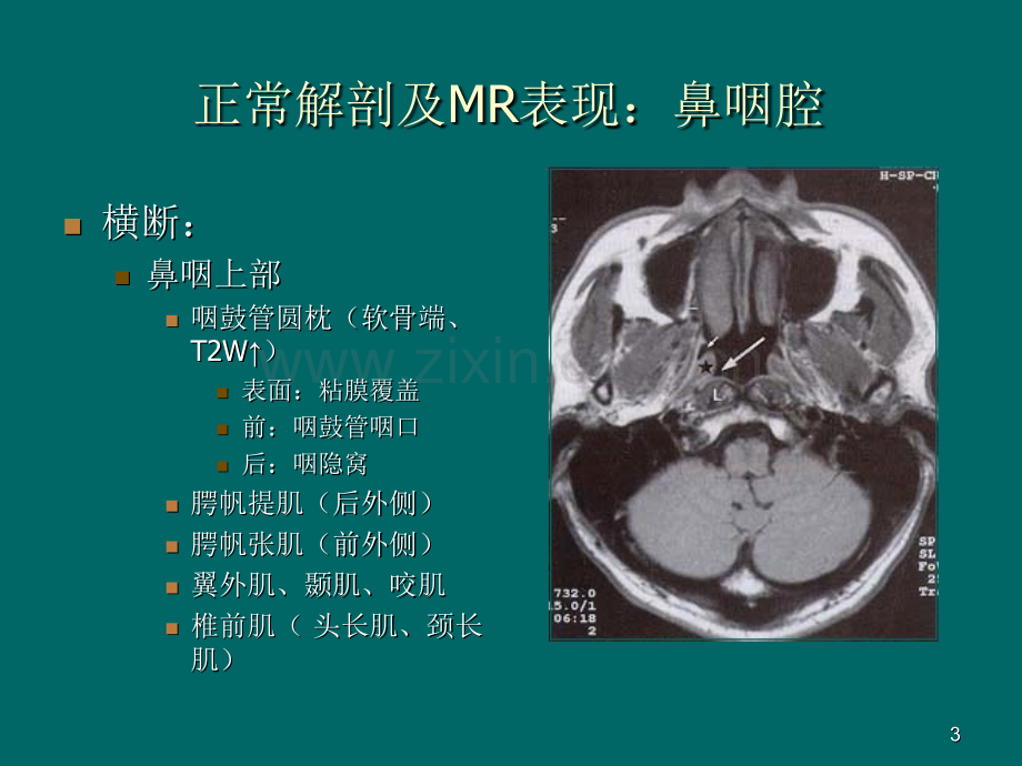 鼻咽癌MR诊断.pptx_第3页