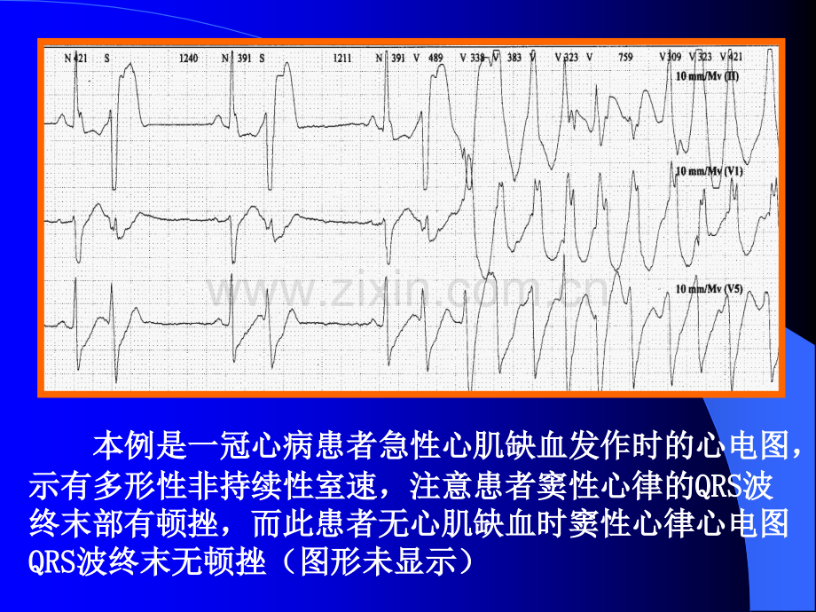 室性早搏治疗原则.pptx_第1页