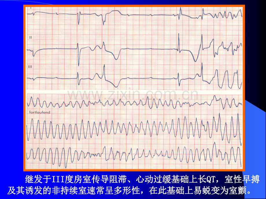 室性早搏治疗原则.pptx_第2页