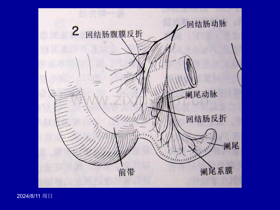 急性阑尾炎手术治疗.pptx_第2页