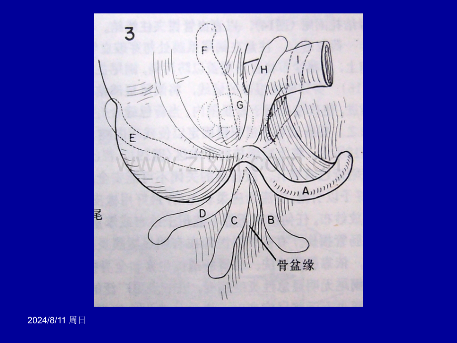 急性阑尾炎手术治疗.pptx_第3页