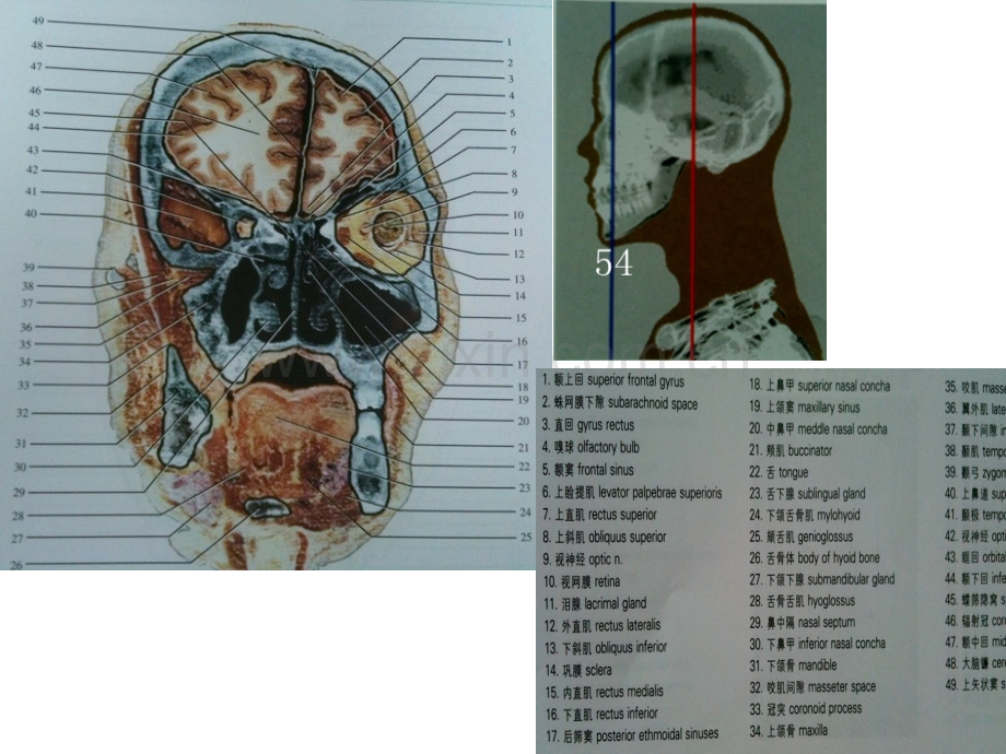 人体断面解剖图谱03-头颅冠状断面.pptx_第2页