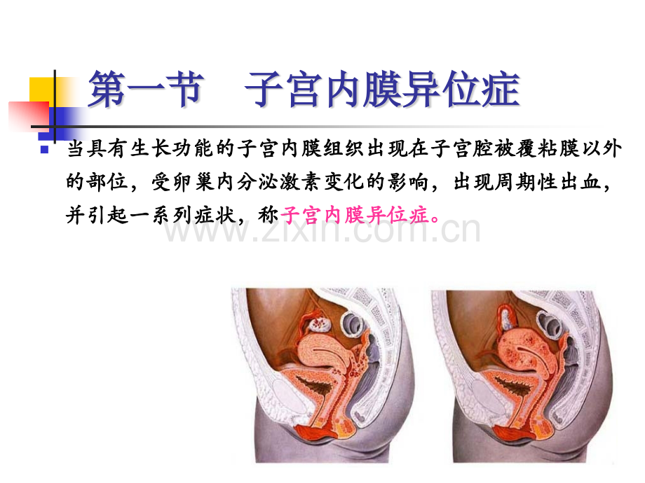 《妇产科护理学》PPT教程课件第18章-妇科其他疾病患者的护理.pptx_第2页