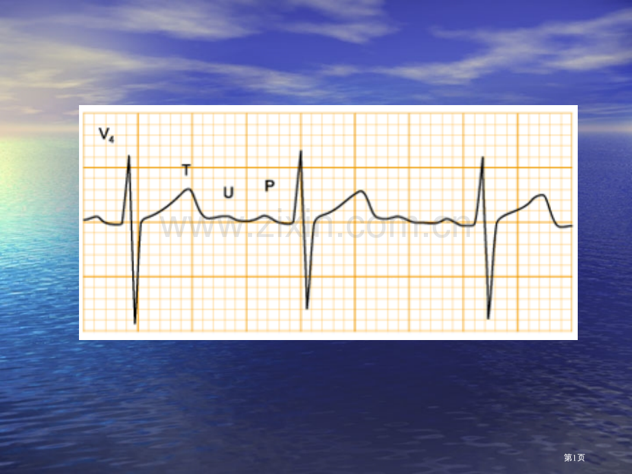 中国区国际心电图培训课程之典型病例市公开课一等奖省优质课赛课一等奖课件.pptx_第1页