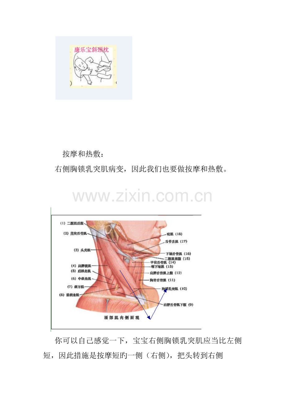 宝宝右侧斜颈的康复方案.doc_第3页