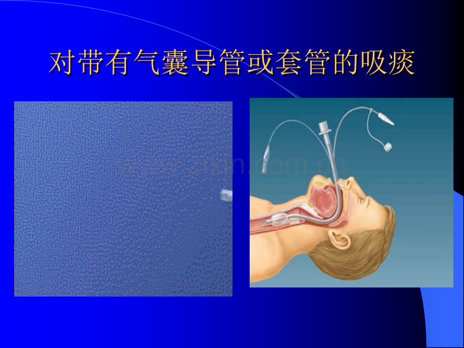 气管切开吸痰.pptx_第3页