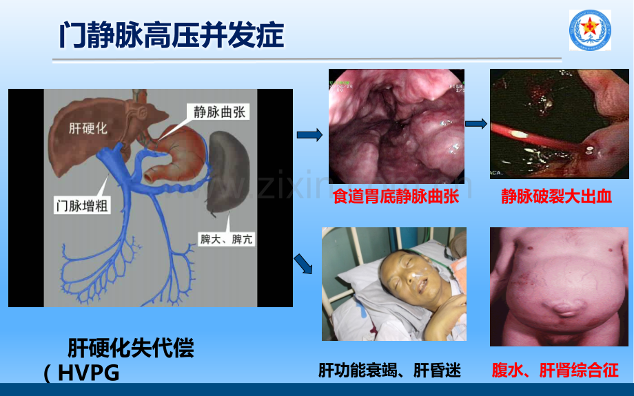 治疗肝硬化门脉高压.pptx_第2页