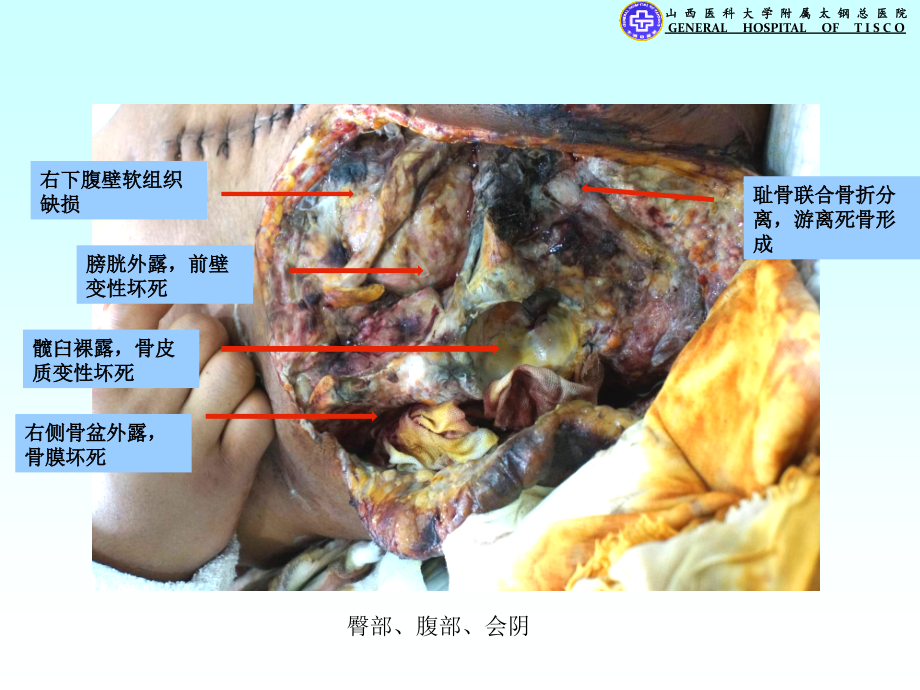 烧伤二科复杂病例.pptx_第3页