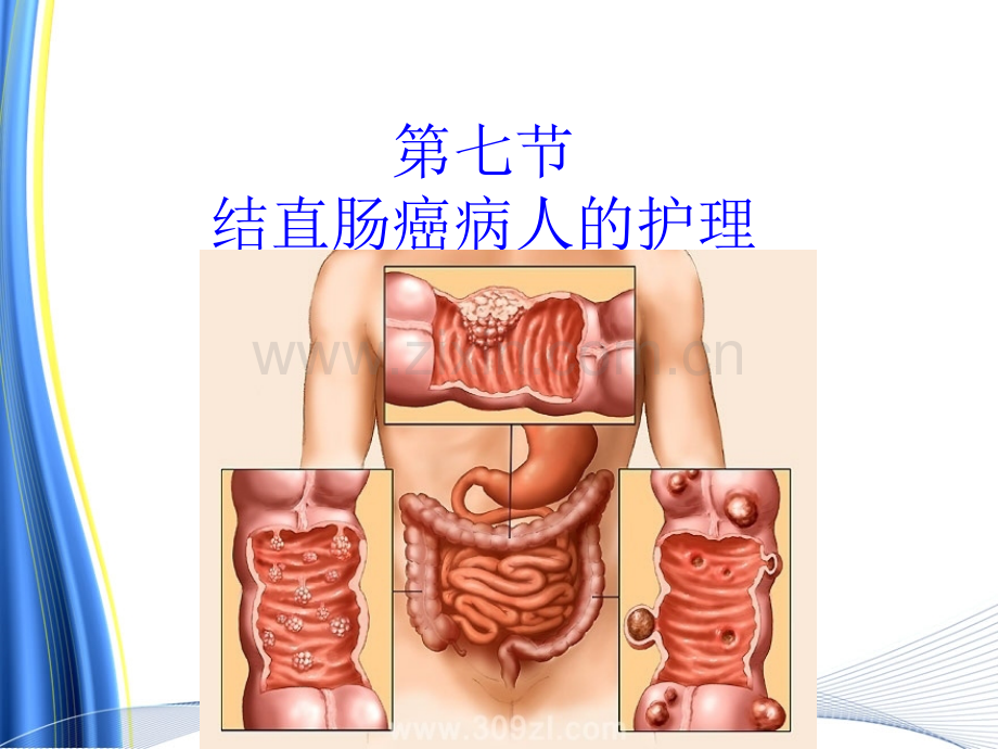 结直肠癌病人的护理.pptx_第3页