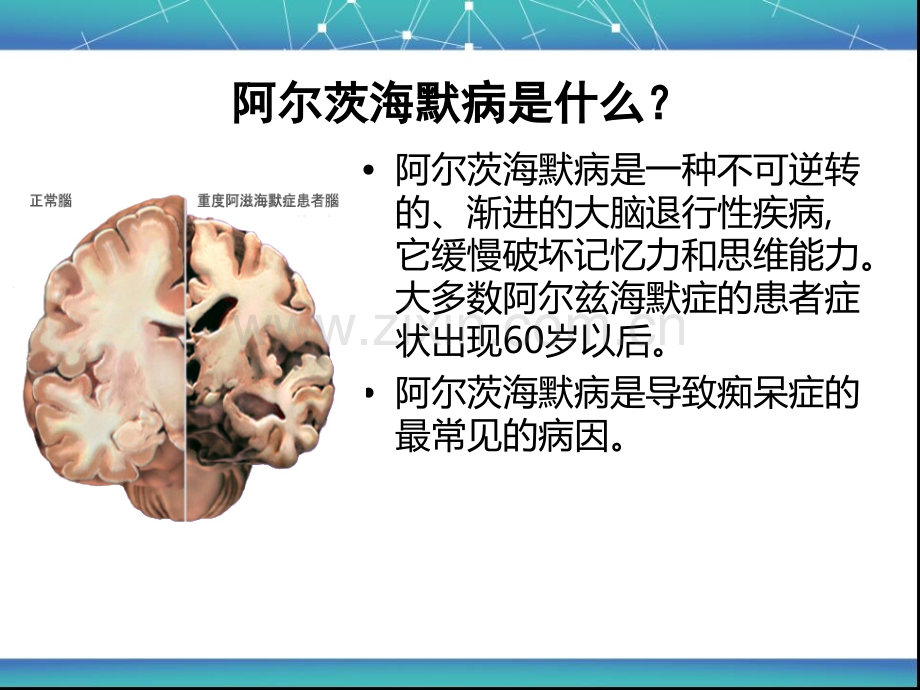 阿尔海默茨氏综合症(老年性痴呆)医学PPT课件.ppt_第2页