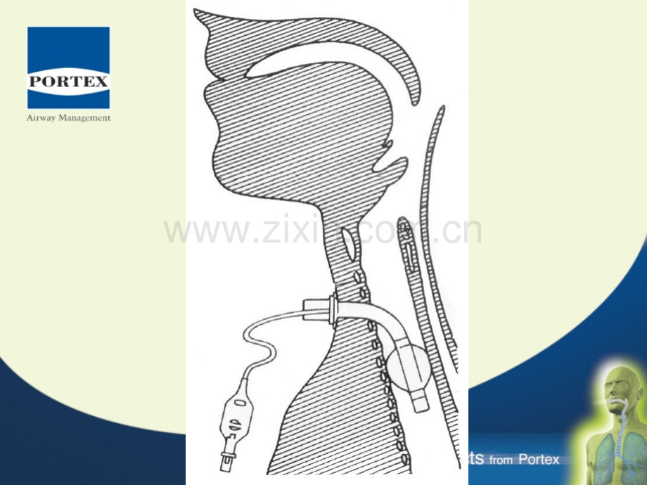 经皮气管切开.pptx_第3页