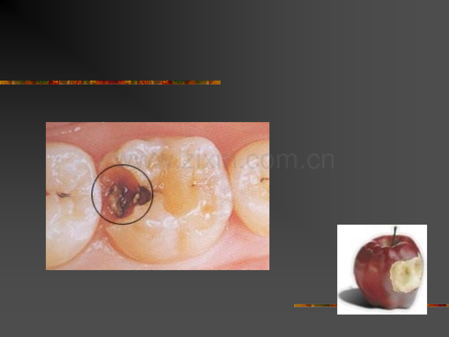 龋病病因新.pptx_第2页