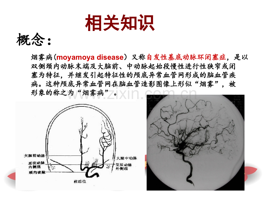 烟雾病护理查房.pptx_第2页