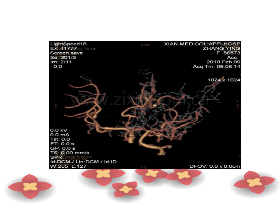 烟雾病护理查房.pptx_第3页