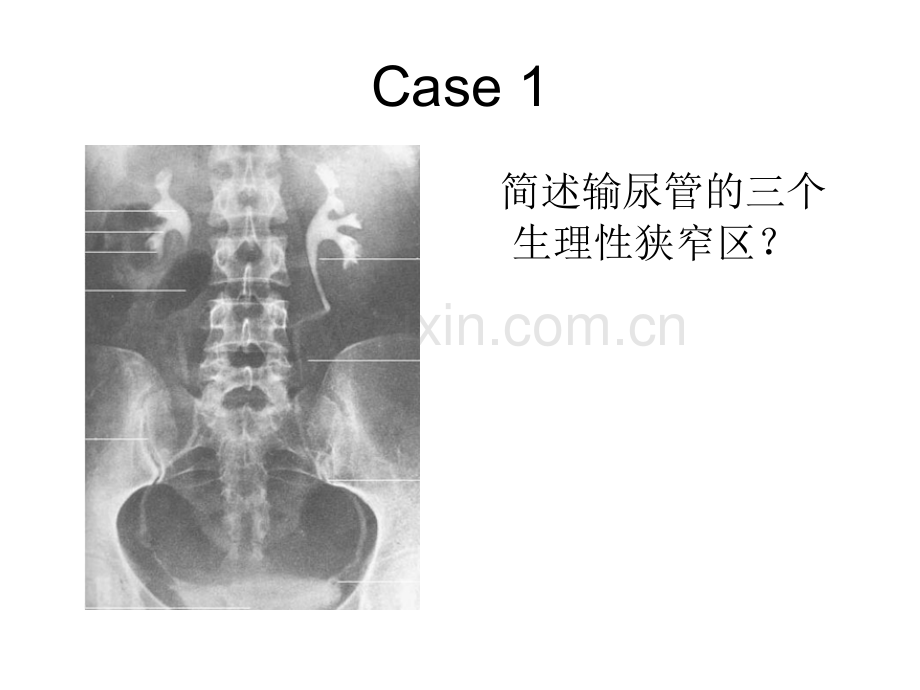 泌尿系常见病多发病.pptx_第1页