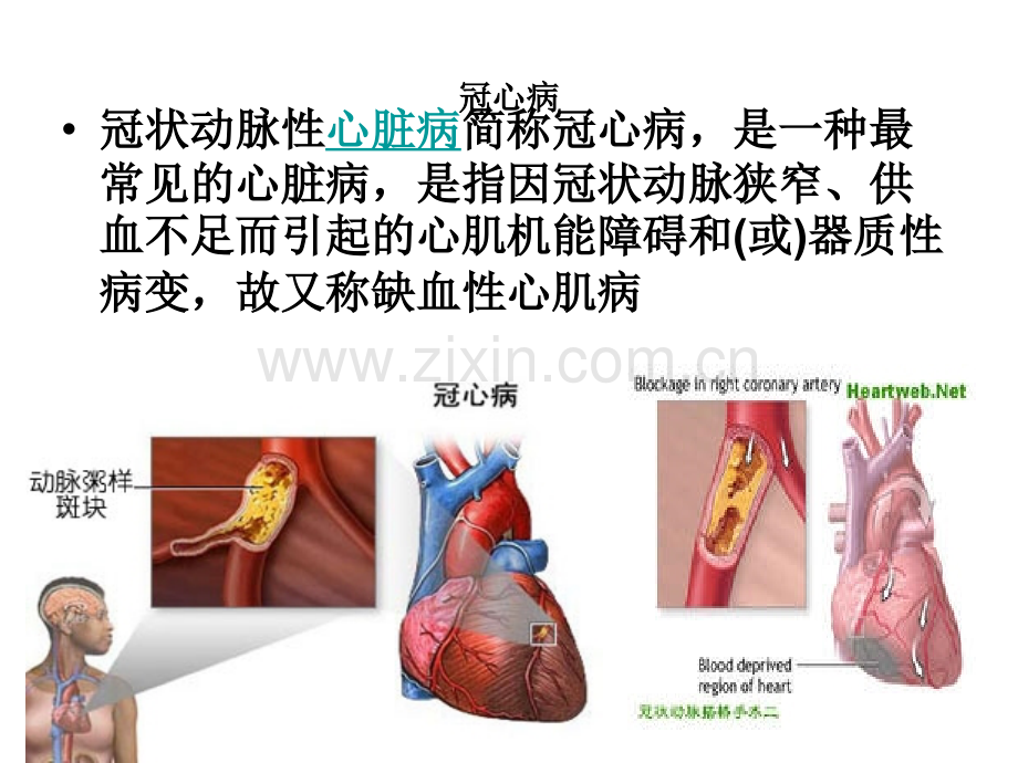 老年医学保健冠心病.pptx_第3页