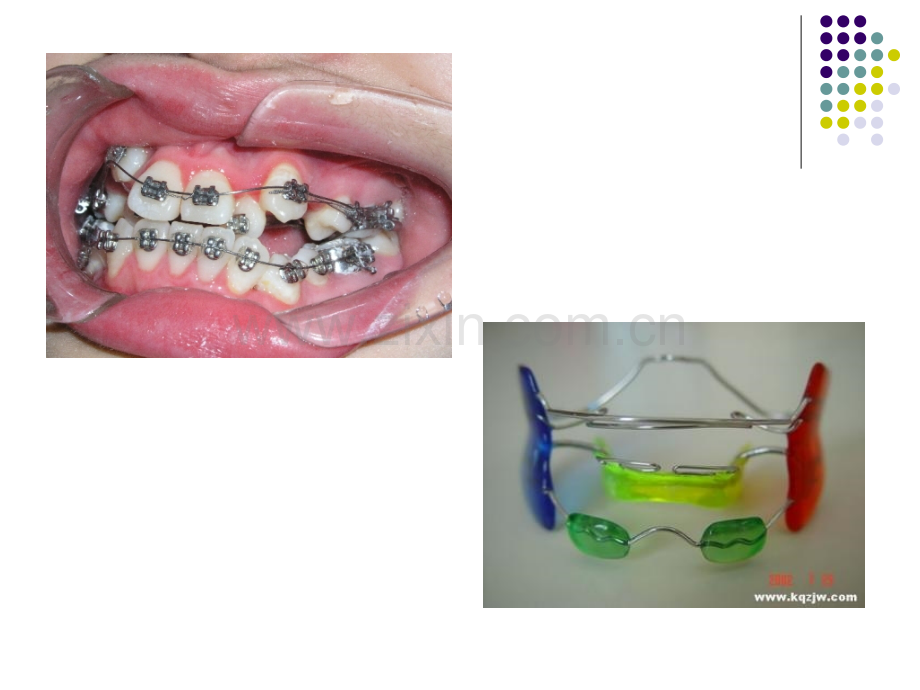 矫治器及其矫治技术.pptx_第3页