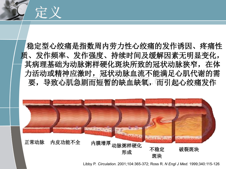 稳定型心绞痛治疗策略.pptx_第1页