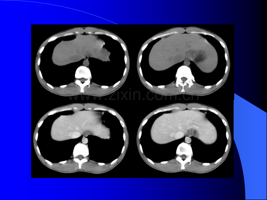 腹部CT诊断普外.pptx_第3页