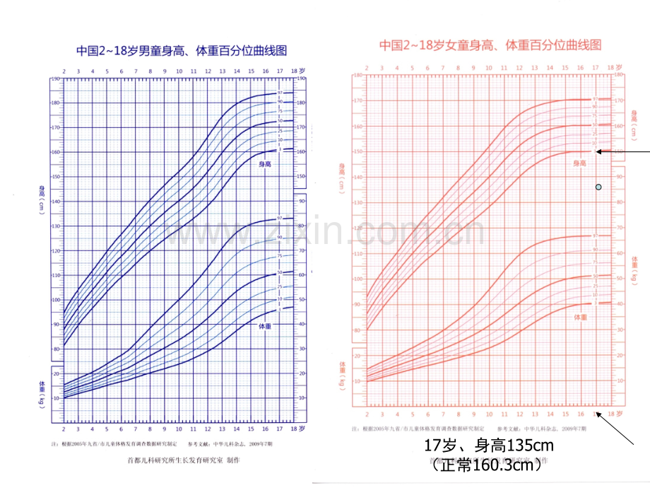 矮身材诊治和骨龄.pptx_第3页