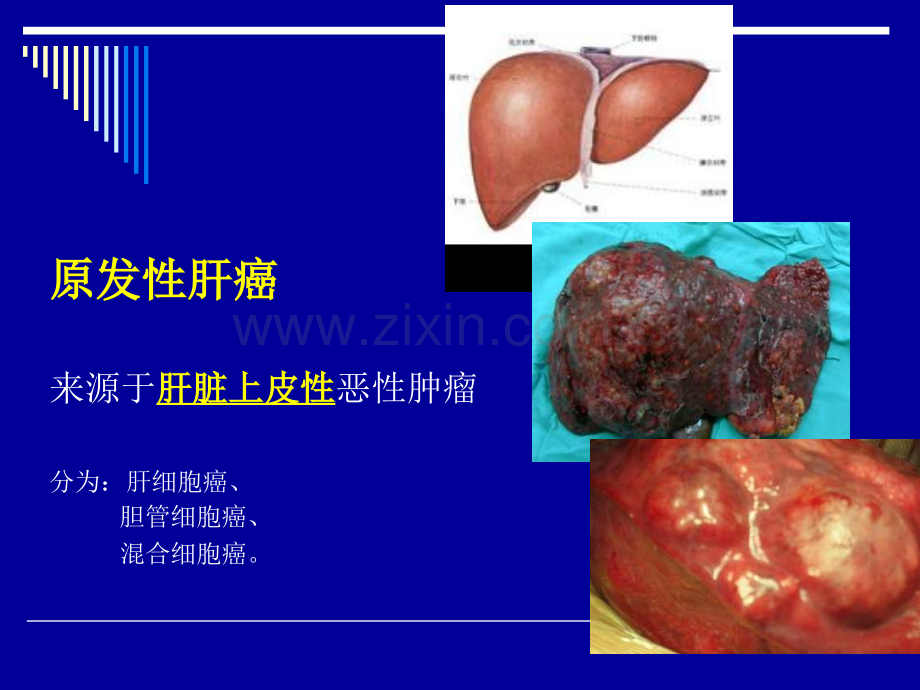 肝癌射频消融及介入治疗.pptx_第3页