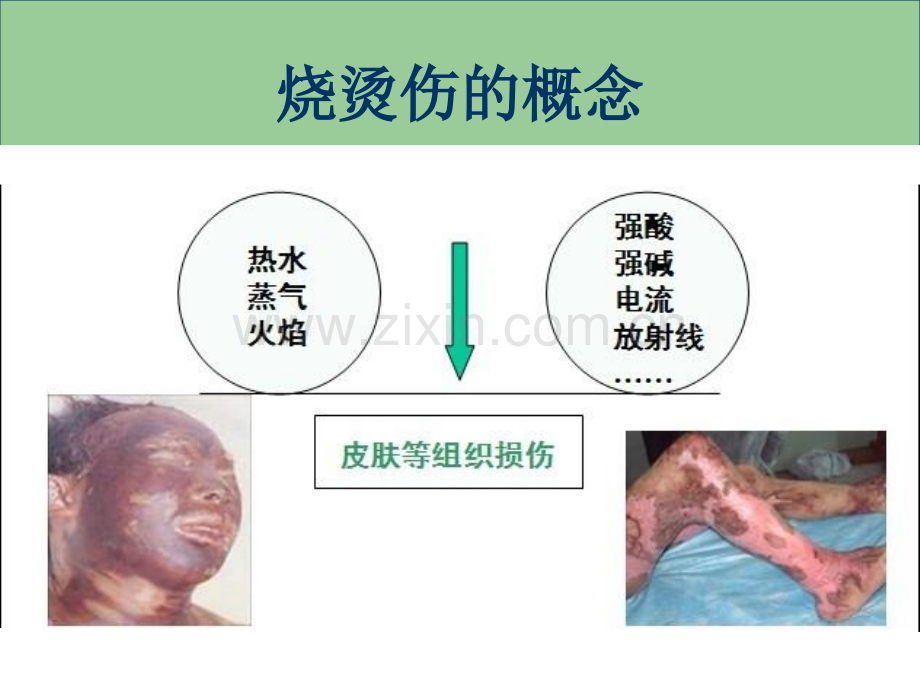 烧烫伤的现场急救.pptx_第2页