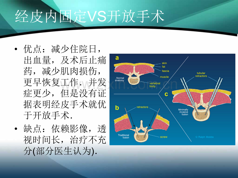 经皮椎弓根螺钉固定的技术.pptx_第2页