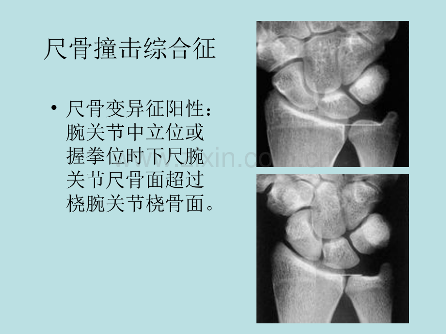 腕关节损伤mr征象.pptx_第1页