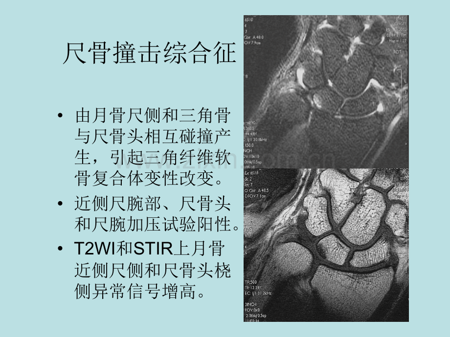 腕关节损伤mr征象.pptx_第2页