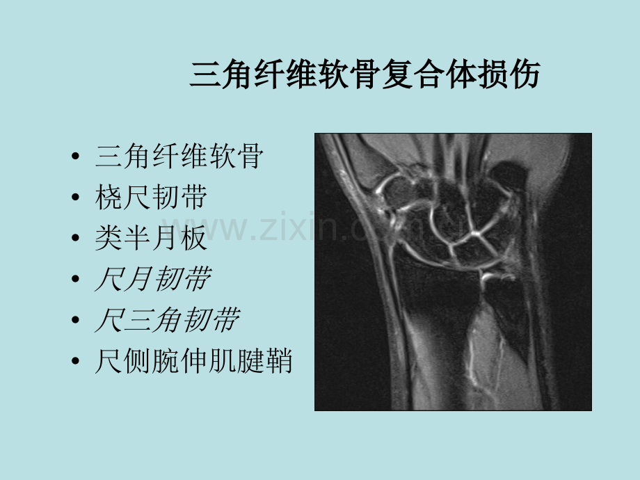 腕关节损伤mr征象.pptx_第3页