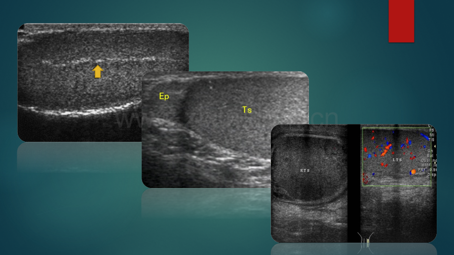 睾丸及附件扭转超声表现.pptx_第3页
