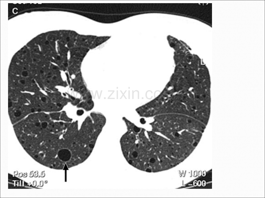 淋巴管肌瘤病的肺部CT表现.pptx_第3页