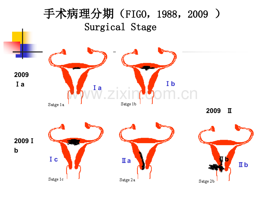 早期子宫内膜癌术后辅助治疗.pptx_第3页